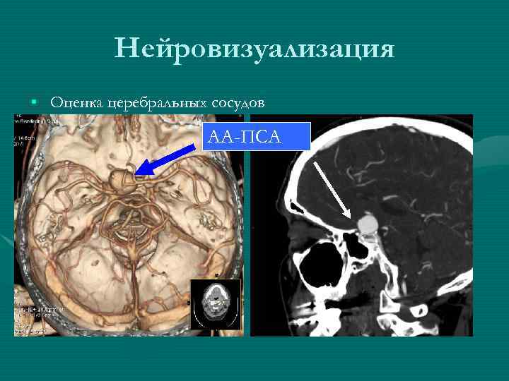Нейровизуализация • Оценка церебральных сосудов АА-ПСА 