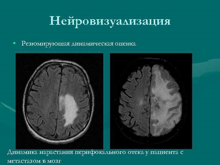 Нейровизуализация • Резюмирующая динамическая оценка Динамика нарастания перифокального отека у пациента с метастазом в