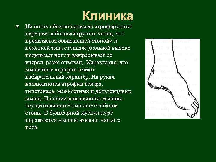 Клиника На ногах обычно первыми атрофируются передняя и боковая группы мышц, что проявляется «свисающей