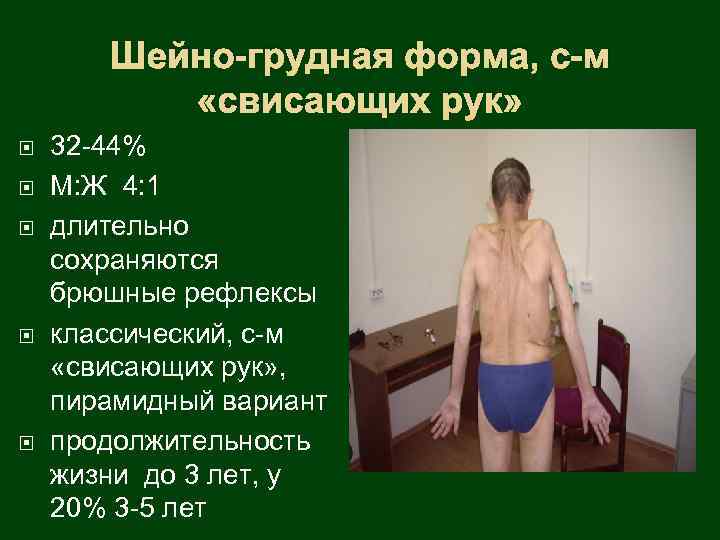 Шейно-грудная форма, с-м «свисающих рук» 32 -44% М: Ж 4: 1 длительно сохраняются брюшные