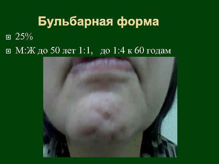 Бульбарная форма 25% М: Ж до 50 лет 1: 1, до 1: 4 к