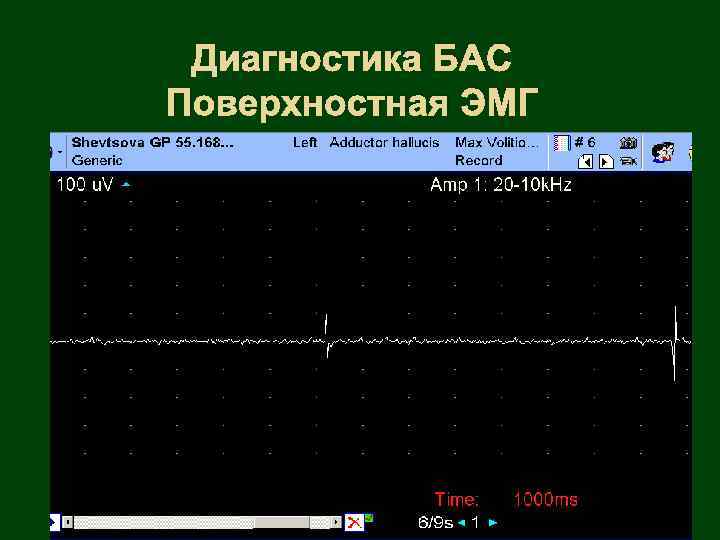 Диагностика БАС Поверхностная ЭМГ ПФц 