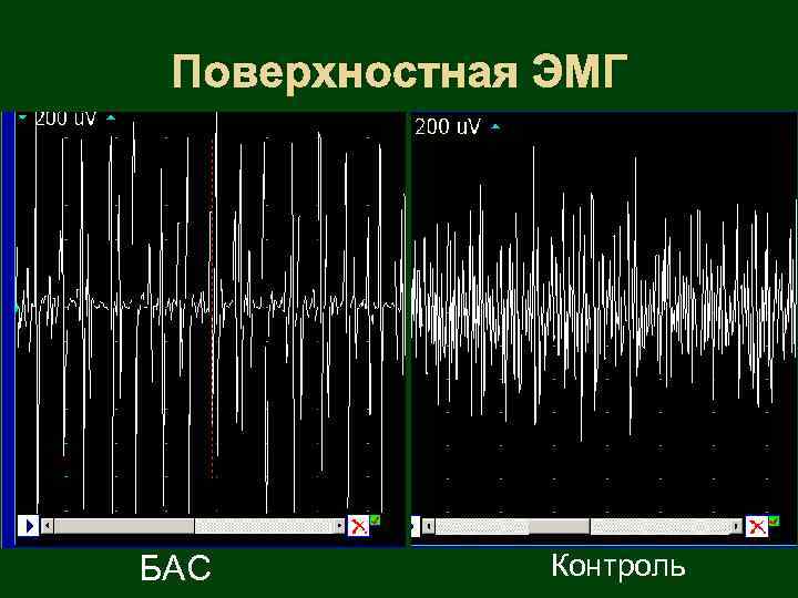 Поверхностная ЭМГ БАС Контроль 
