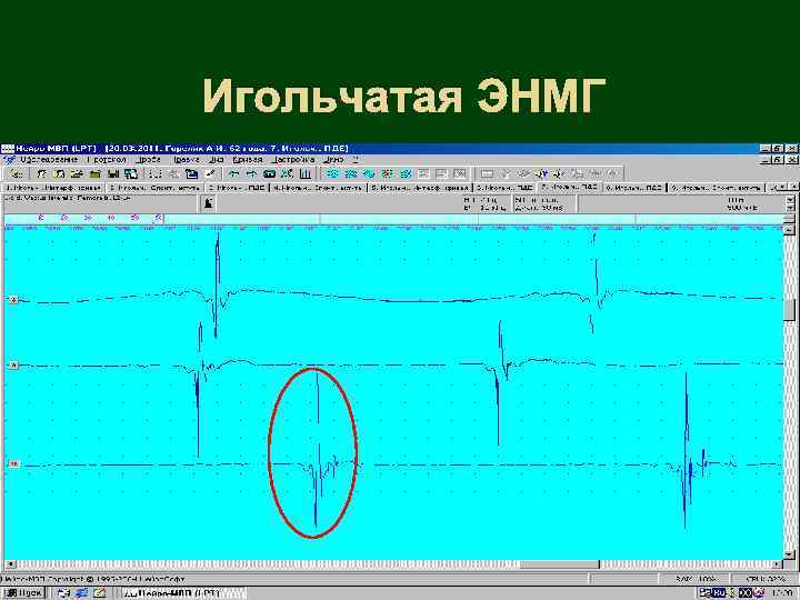 Игольчатая ЭНМГ 