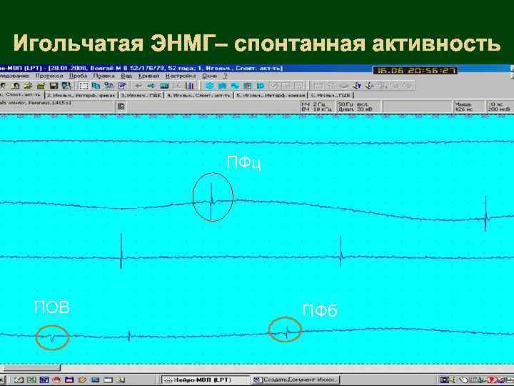 Игольчатая ЭНМГ– спонтанная активность ПФц ПОВ ПФб 