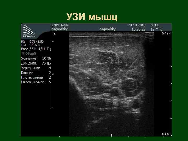 УЗИ мышц 