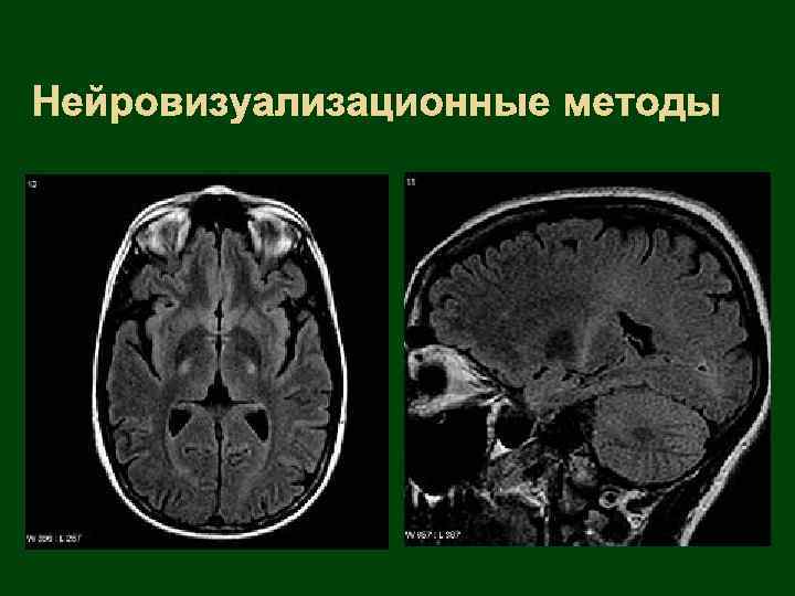 Нейровизуализационные методы 
