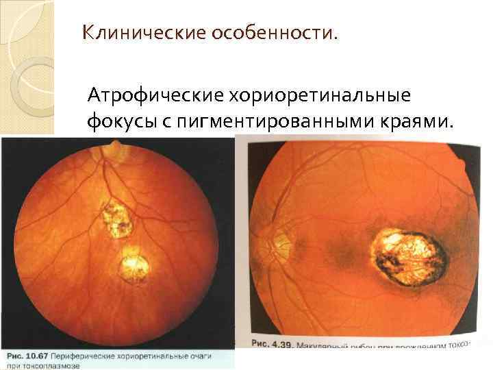 Клинические особенности. Атрофические хориоретинальные фокусы с пигментированными краями. 