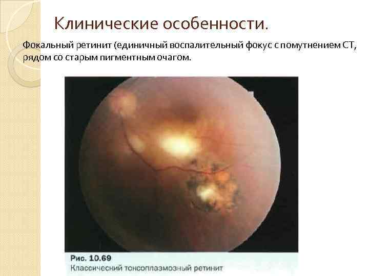Клинические особенности. Фокальный ретинит (единичный воспалительный фокус с помутнением СТ, рядом со старым пигментным