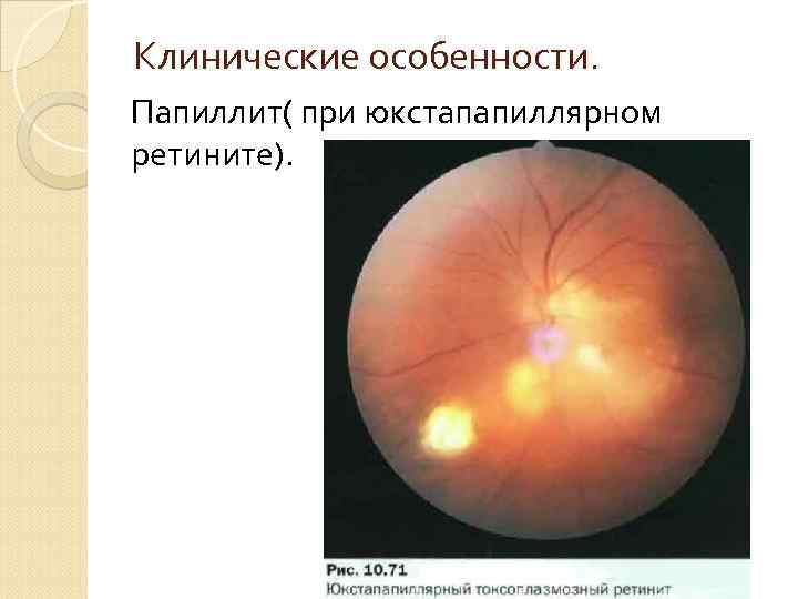 Клинические особенности. Папиллит( при юкстапапиллярном ретините). 