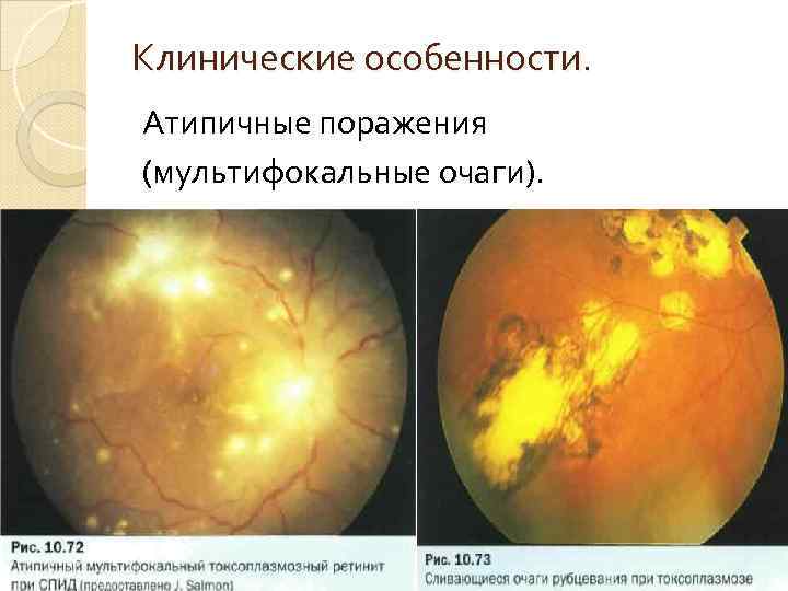 Клинические особенности. Атипичные поражения (мультифокальные очаги). 