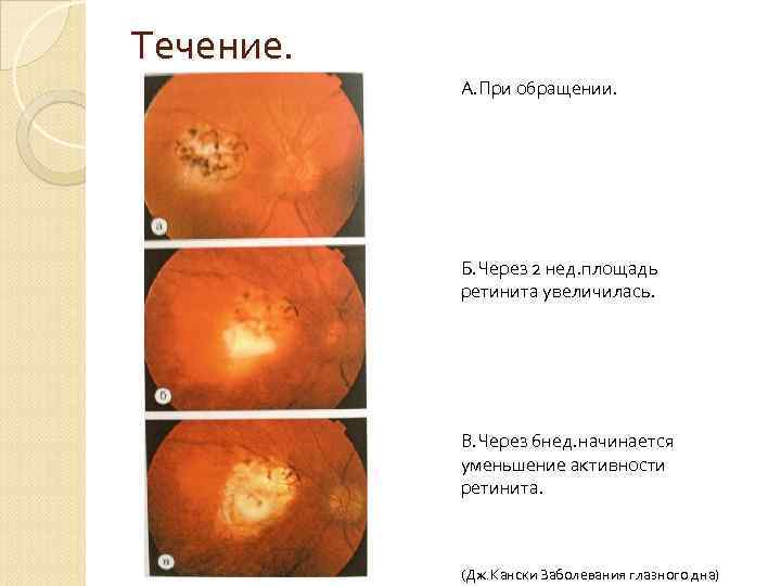 Течение. А. При обращении. Б. Через 2 нед. площадь ретинита увеличилась. В. Через 6