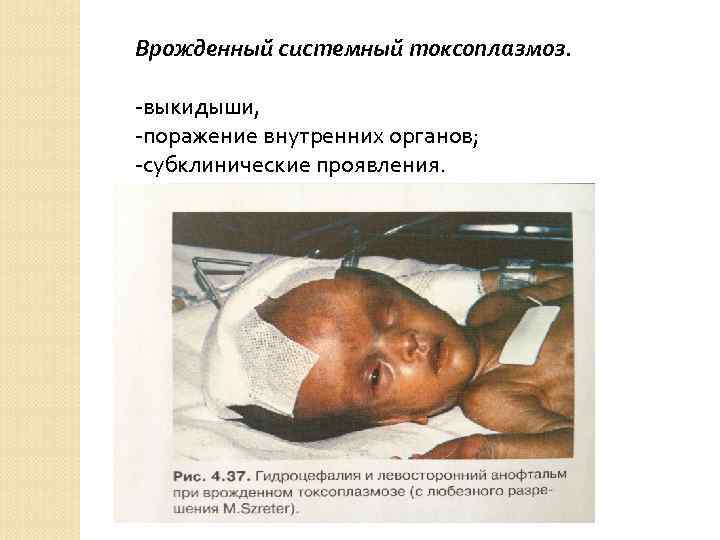 Врожденный системный токсоплазмоз. -выкидыши, -поражение внутренних органов; -субклинические проявления. 