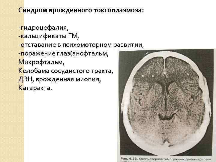 Синдром врожденного токсоплазмоза: -гидроцефалия, -кальцификаты ГМ, -отставание в психомоторном развитии, -поражение глаз(анофтальм, Микрофтальм, Колобама