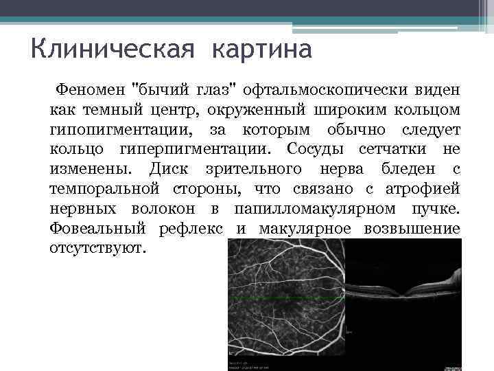 Клиническая картина Феномен "бычий глаз" офтальмоскопически виден как темный центр, окруженный широким кольцом гипопигментации,