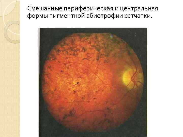 Смешанные периферическая и центральная формы пигментной абиотрофии сетчатки. 