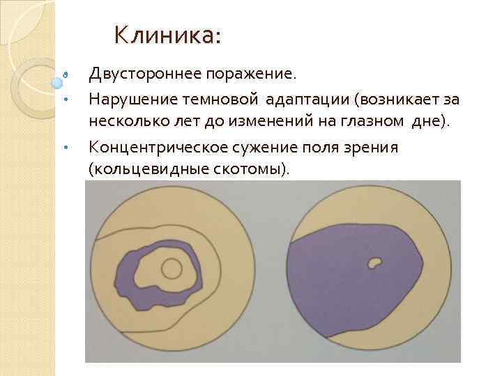 Клиника: • • • Двустороннее поражение. Нарушение темновой адаптации (возникает за несколько лет до