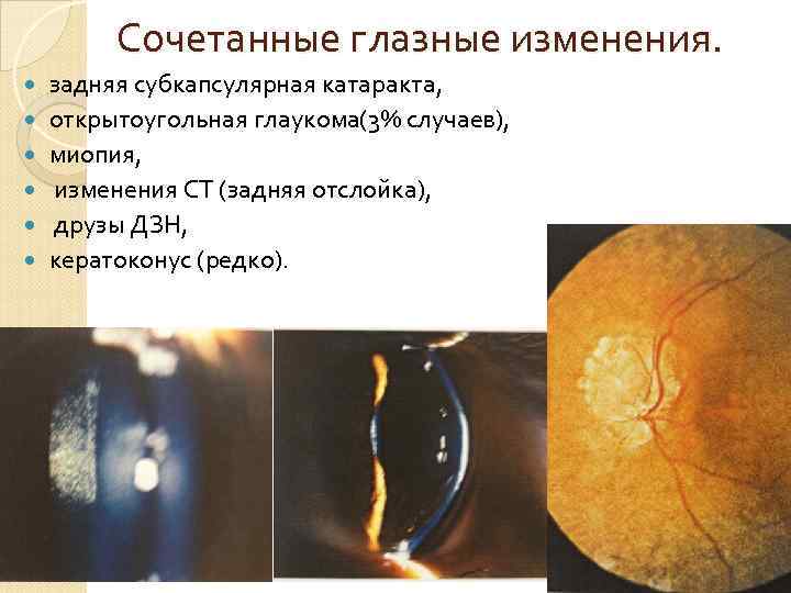 Сочетанные глазные изменения. задняя субкапсулярная катаракта, открытоугольная глаукома(3% случаев), миопия, изменения СТ (задняя отслойка),
