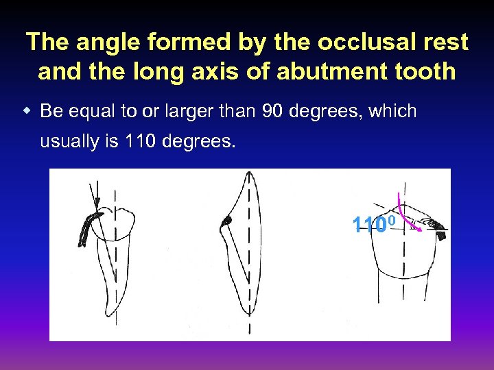 The angle formed by the occlusal rest and the long axis of abutment tooth