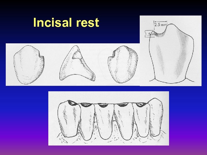 Incisal rest 