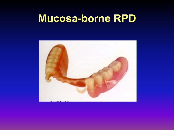 Mucosa-borne RPD 