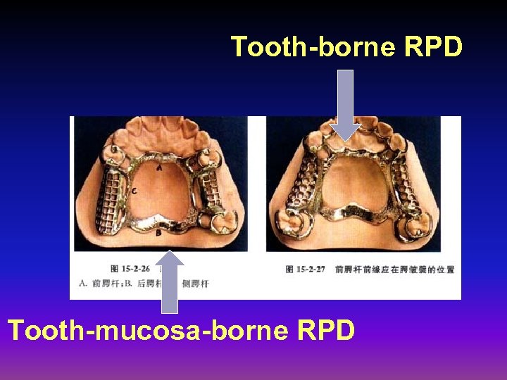 Tooth-borne RPD Tooth-mucosa-borne RPD 