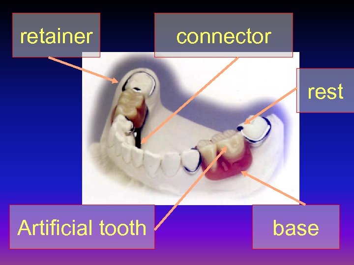 retainer connector rest Artificial tooth base 