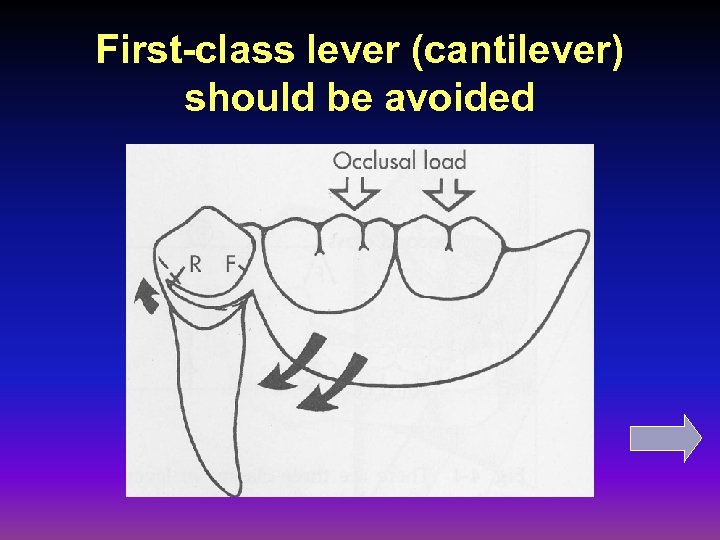 First-class lever (cantilever) should be avoided 