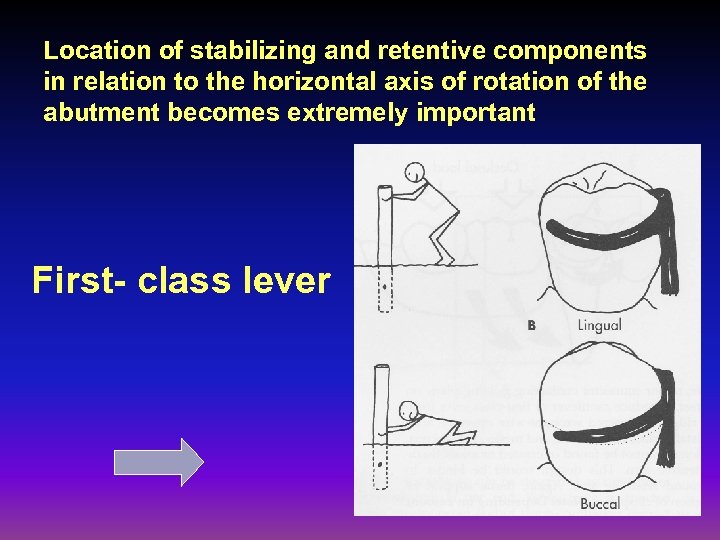 Location of stabilizing and retentive components in relation to the horizontal axis of rotation