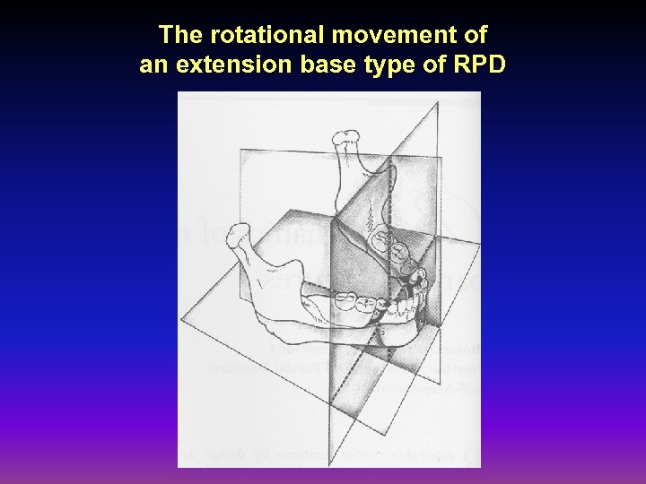 The rotational movement of an extension base type of RPD 