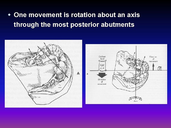 w One movement is rotation about an axis through the most posterior abutments 