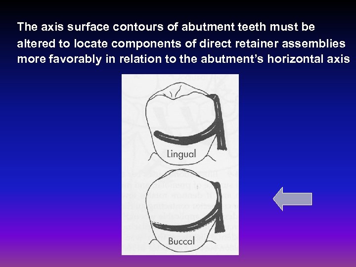 The axis surface contours of abutment teeth must be altered to locate components of