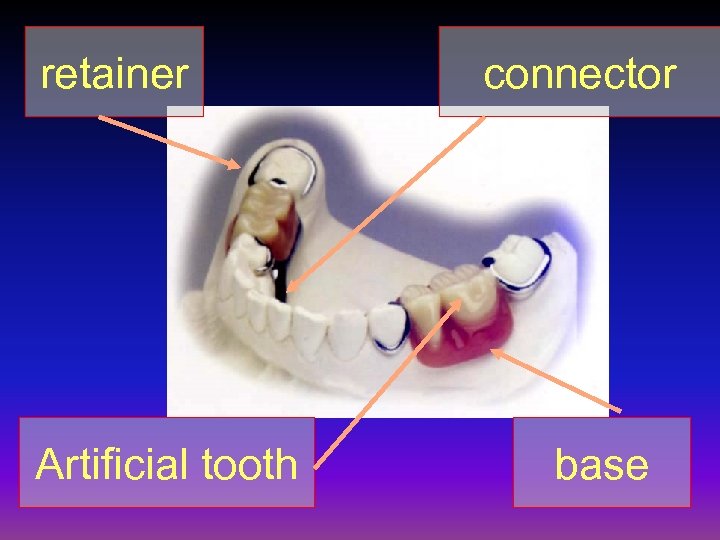 retainer Artificial tooth connector base 