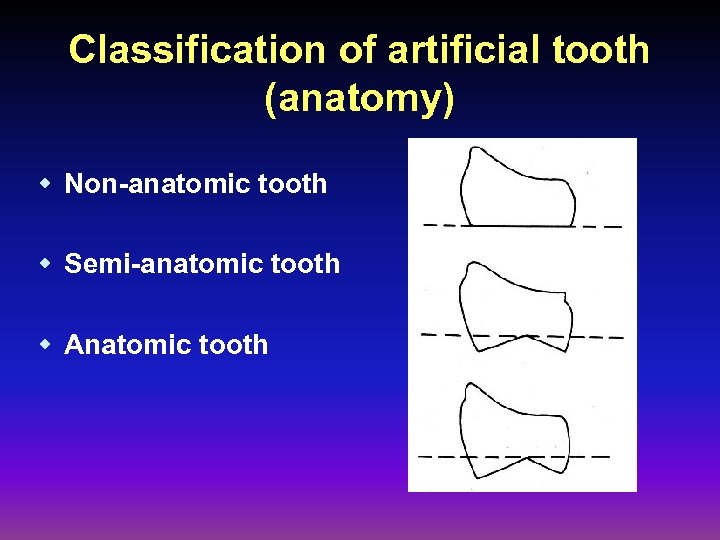 Classification of artificial tooth (anatomy) w Non-anatomic tooth w Semi-anatomic tooth w Anatomic tooth