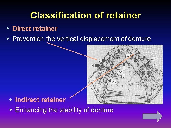 Classification of retainer w Direct retainer w Prevention the vertical displacement of denture w