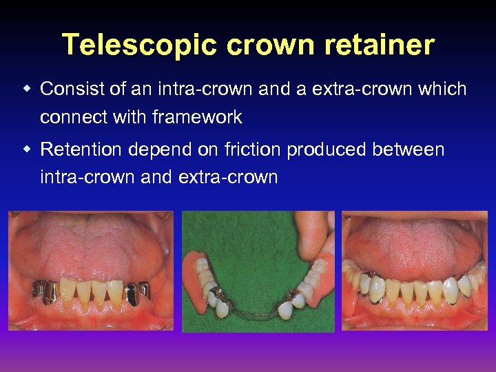 Telescopic crown retainer w Consist of an intra-crown and a extra-crown which connect with