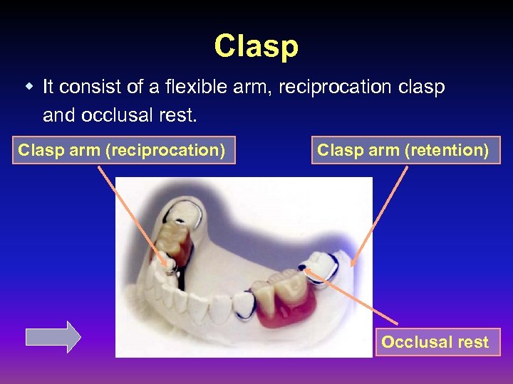 Clasp w It consist of a flexible arm, reciprocation clasp and occlusal rest. Clasp