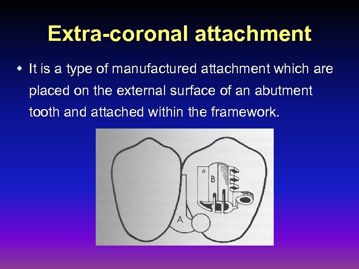 Extra-coronal attachment w It is a type of manufactured attachment which are placed on