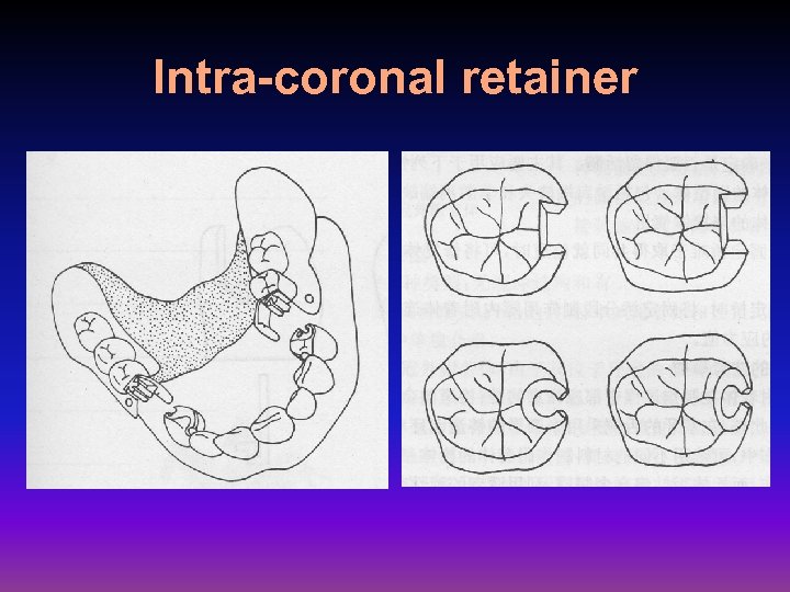 Intra-coronal retainer 