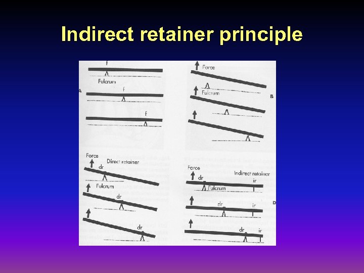 Indirect retainer principle 