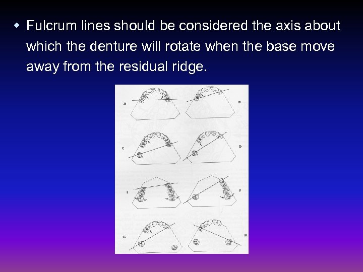 w Fulcrum lines should be considered the axis about which the denture will rotate