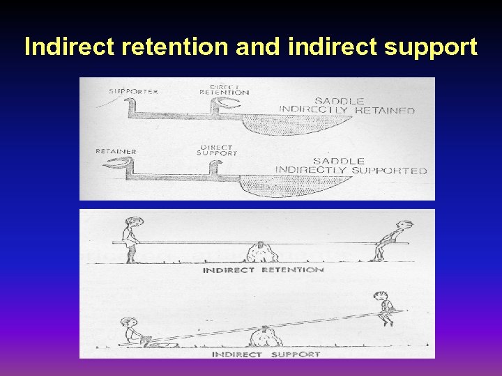 Indirect retention and indirect support 