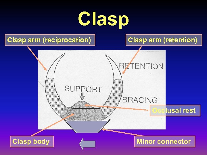 Clasp arm (reciprocation) Clasp arm (retention) Occlusal rest Clasp body Minor connector 