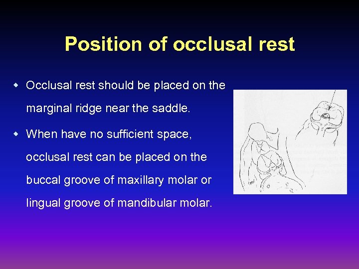 Position of occlusal rest w Occlusal rest should be placed on the marginal ridge