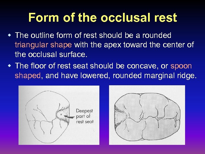 Form of the occlusal rest w The outline form of rest should be a