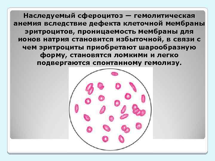 Наследуемый сфероцитоз — гемолитическая анемия вследствие дефекта клеточной мембраны эритроцитов, проницаемость мембраны для ионов