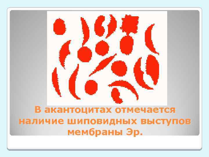 В акантоцитах отмечается наличие шиповидных выступов мембраны Эр. 