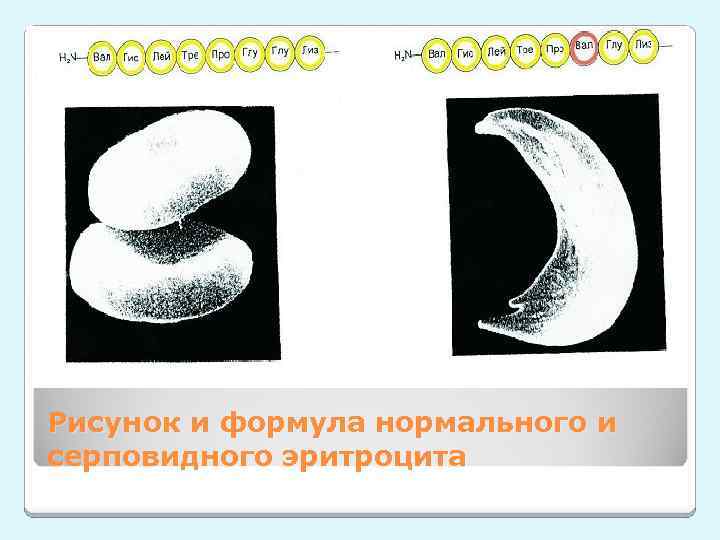 Рисунок и формула нормального и серповидного эритроцита 