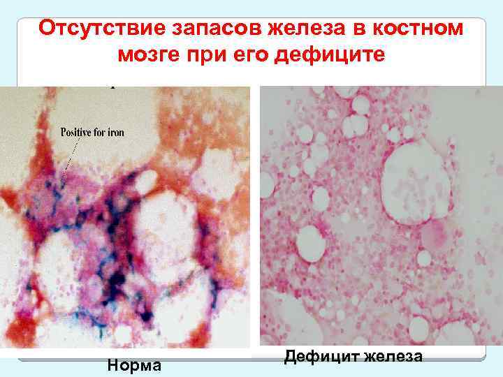 Отсутствие запасов железа в костном мозге при его дефиците Норма Дефицит железа 