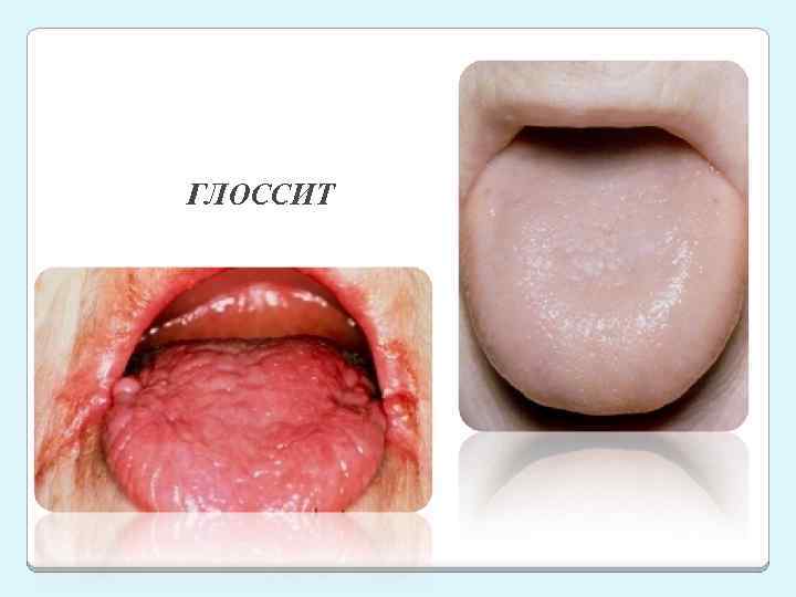 ГЛОССИТ 
